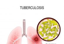 Number of TB cases in M’sia on the decline – Health D-G